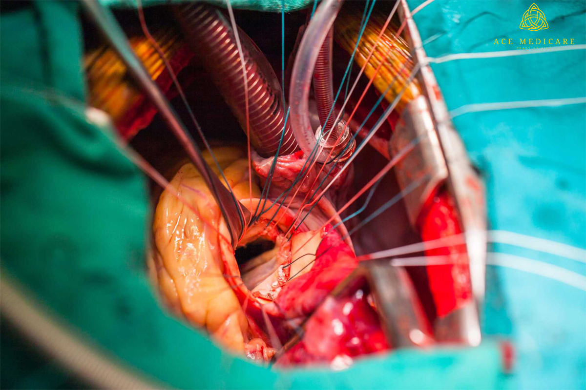 The Role of Rehabilitation in the Success of Valve Replacement Surgery